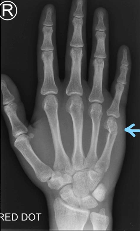 boxer's fracture metal plate|broken boxer's bone.